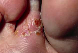 Fungus between the toes