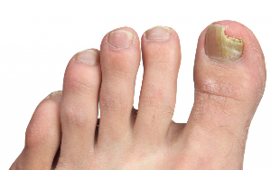 fungus toenails stage