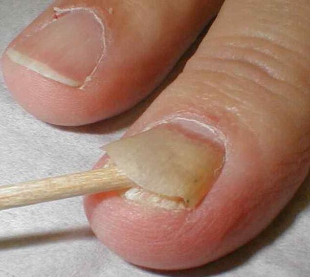peeling of the nail with fungus on the nail