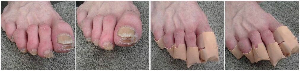 Application of adhesives for fungus on toenails