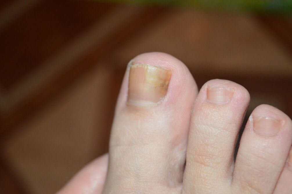 The early stage of toenail fungus