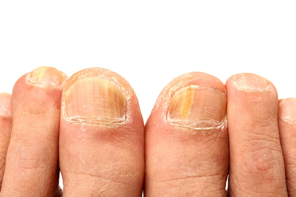 how is nail fungus
