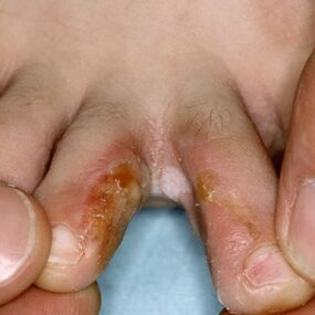 Signs of fungus between your toes
