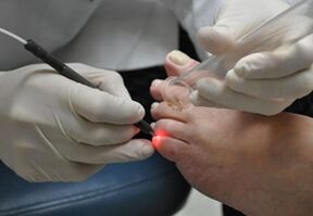 Laser treatment for nail fungus