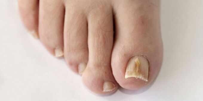 Nail fungus