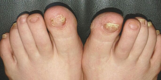 Ynichomycosis of nails on the legs