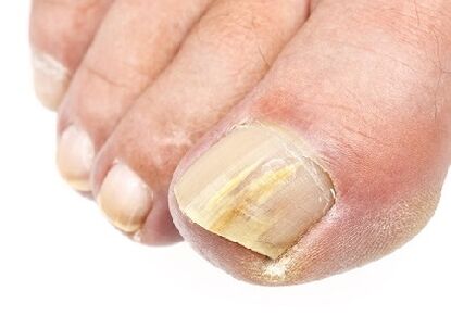 How is the nail fungus