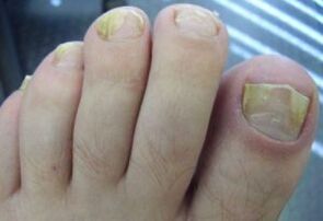 Affected by the nail with fungal infections