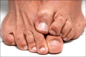 itchy skin on the feet due to a fungal nail infection