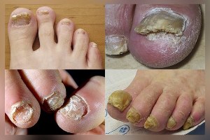 nail fungus