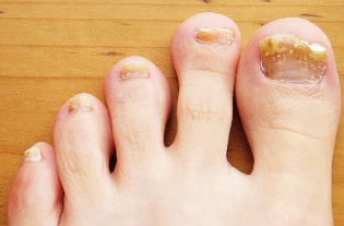 Nail fungus