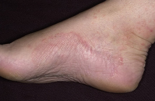 Fungus on the foot