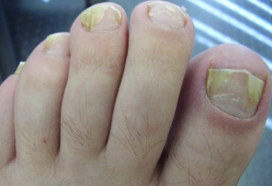 Nail fungus